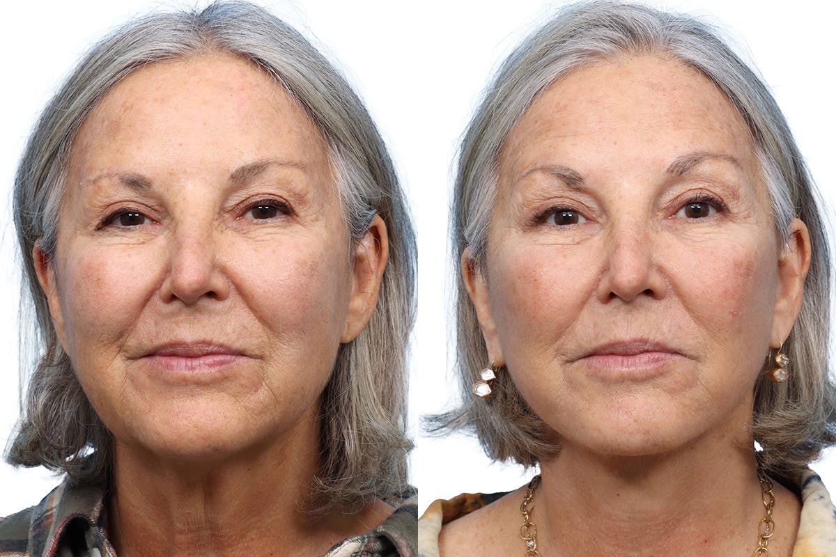 Deep Plane Facelift Before & After Gallery - Patient 785463 - Image 1