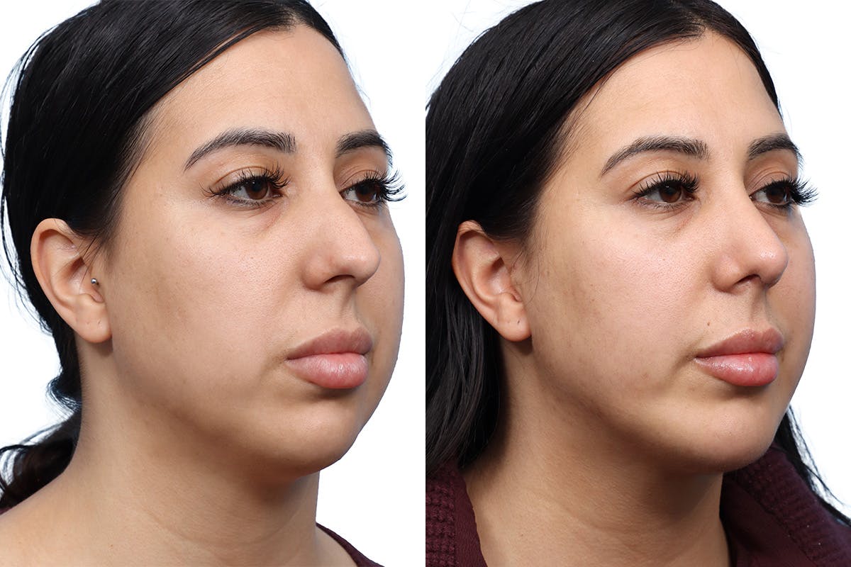 Chin Augmentation Before & After Gallery - Patient 325042 - Image 2