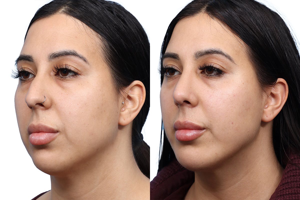 Chin Augmentation Before & After Gallery - Patient 325042 - Image 3