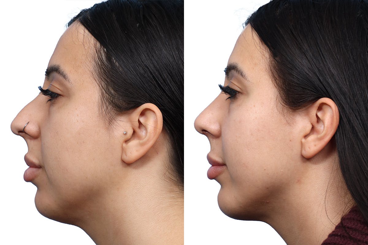 Chin Augmentation Before & After Gallery - Patient 325042 - Image 1
