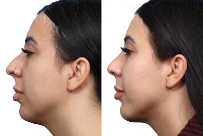 Chin Augmentation Before & After Gallery - Patient 325042 - Image 1