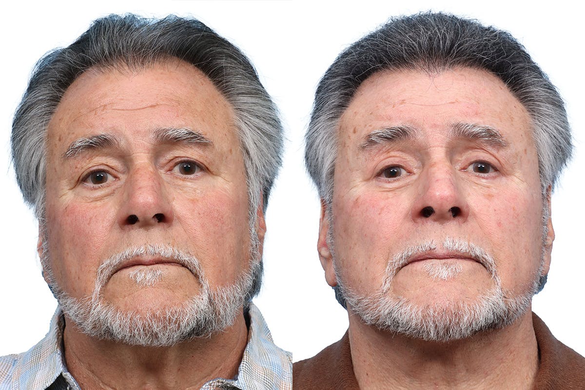 Blepharoplasty (Eyelid Surgery) Before & After Gallery - Patient 196894 - Image 1