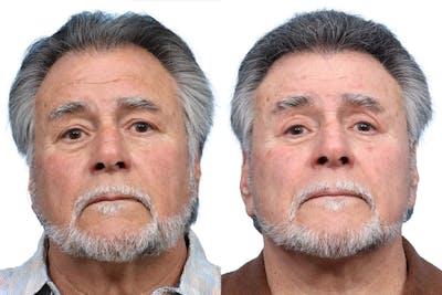 Blepharoplasty (Eyelid Surgery) Before & After Gallery - Patient 196894 - Image 1