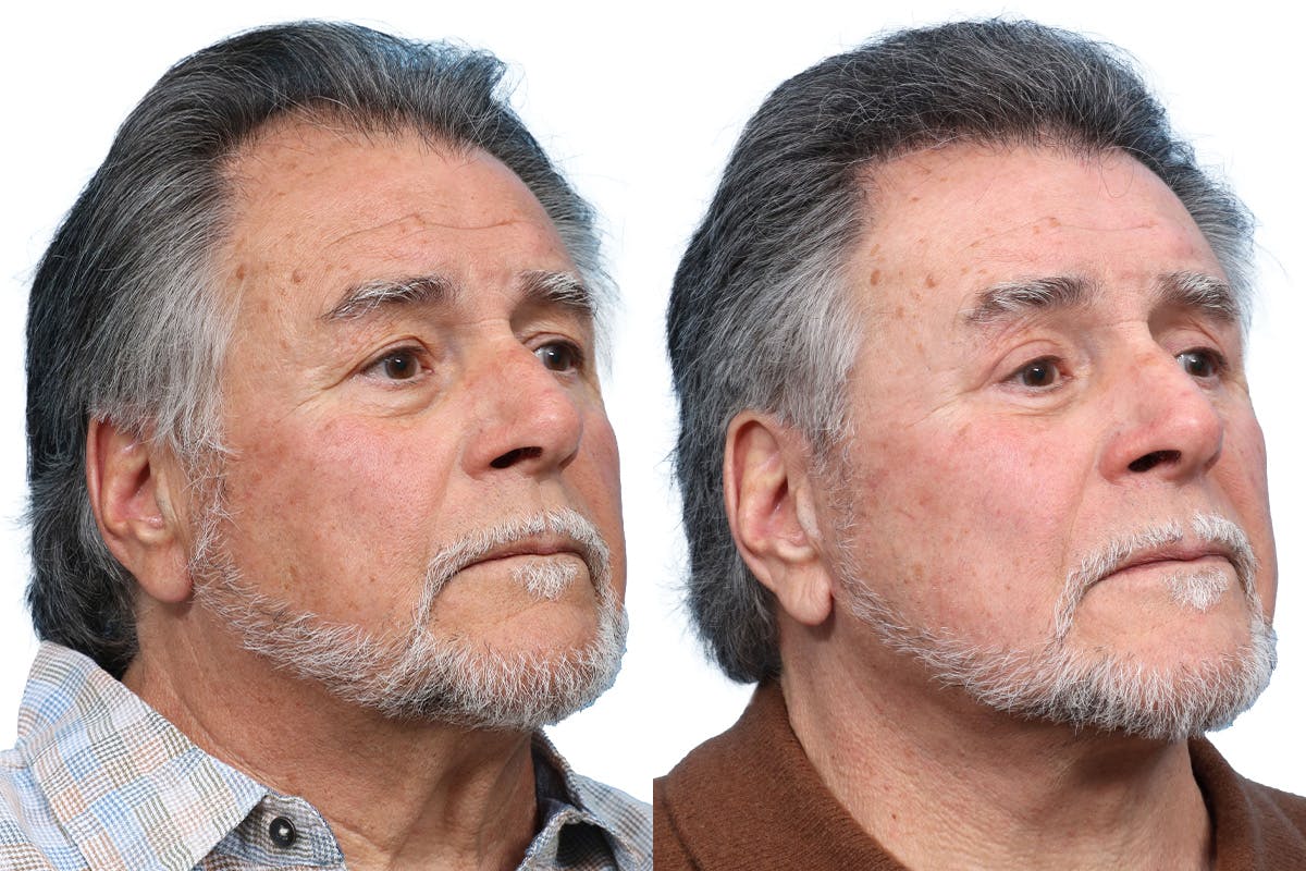 Blepharoplasty (Eyelid Surgery) Before & After Gallery - Patient 196894 - Image 2