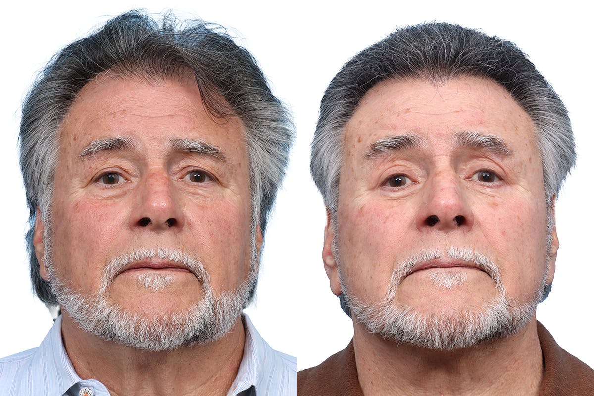 Deep Plane Facelift Before & After Gallery - Patient 408034 - Image 1