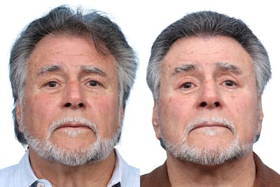 Deep Plane Facelift Before & After Gallery - Patient 408034 - Image 1