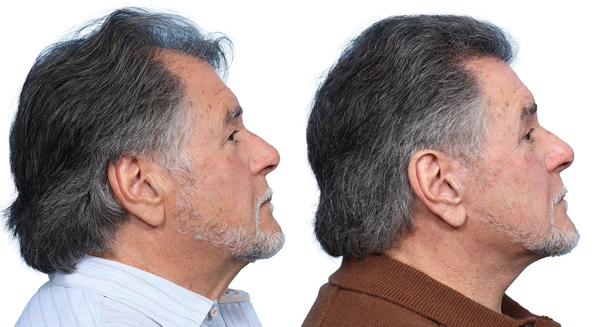 Deep Plane Facelift Before & After Gallery - Patient 408034 - Image 2