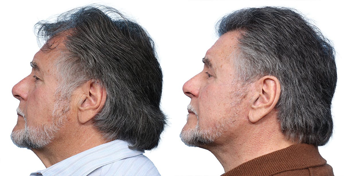 Deep Plane Facelift Before & After Gallery - Patient 408034 - Image 3