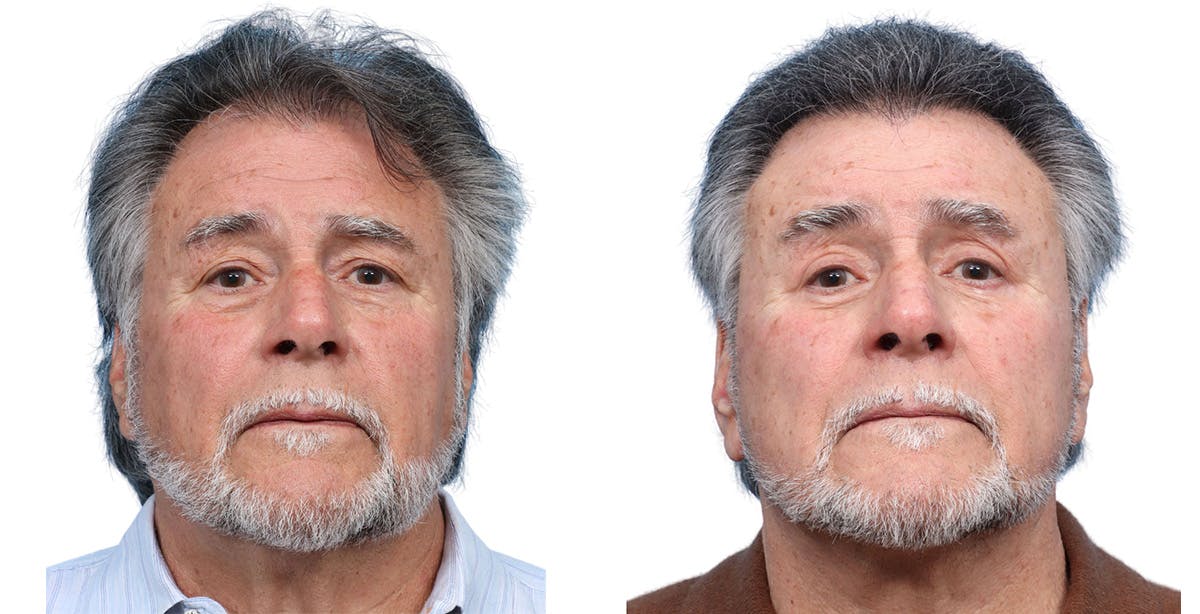 FUE Hair Transplant Before & After Gallery - Patient 168232 - Image 1