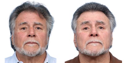 FUE Hair Transplant Before & After Gallery - Patient 168232 - Image 1