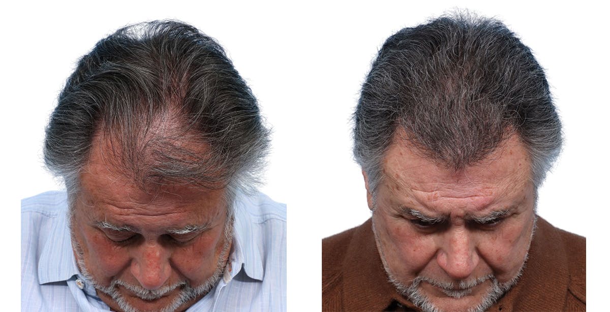 FUE Hair Transplant Before & After Gallery - Patient 168232 - Image 2