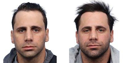 FUE Hair Transplant Before & After Gallery - Patient 357341 - Image 1