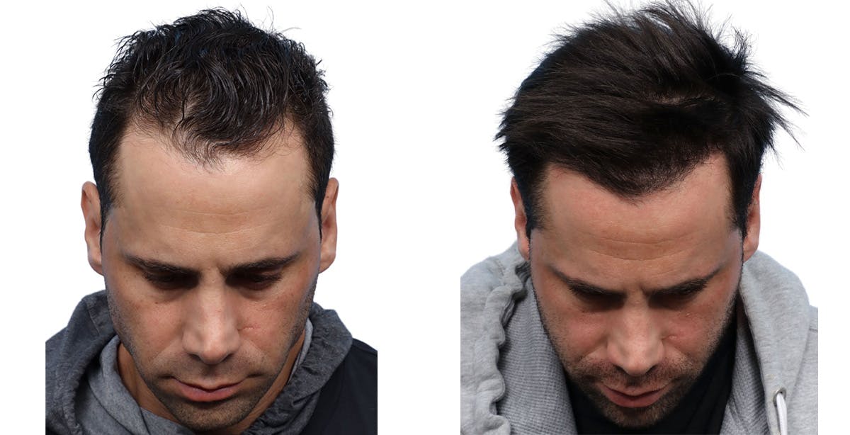 FUE Hair Transplant Before & After Gallery - Patient 202402 - Image 2