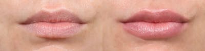 Lip Enhancement Before & After Gallery - Patient 385114 - Image 1