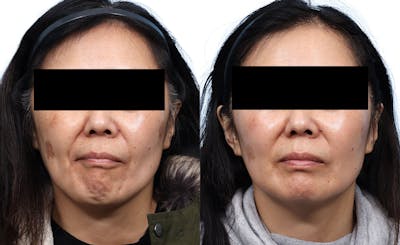 Chemical Peels Before & After Gallery - Patient 426041 - Image 1