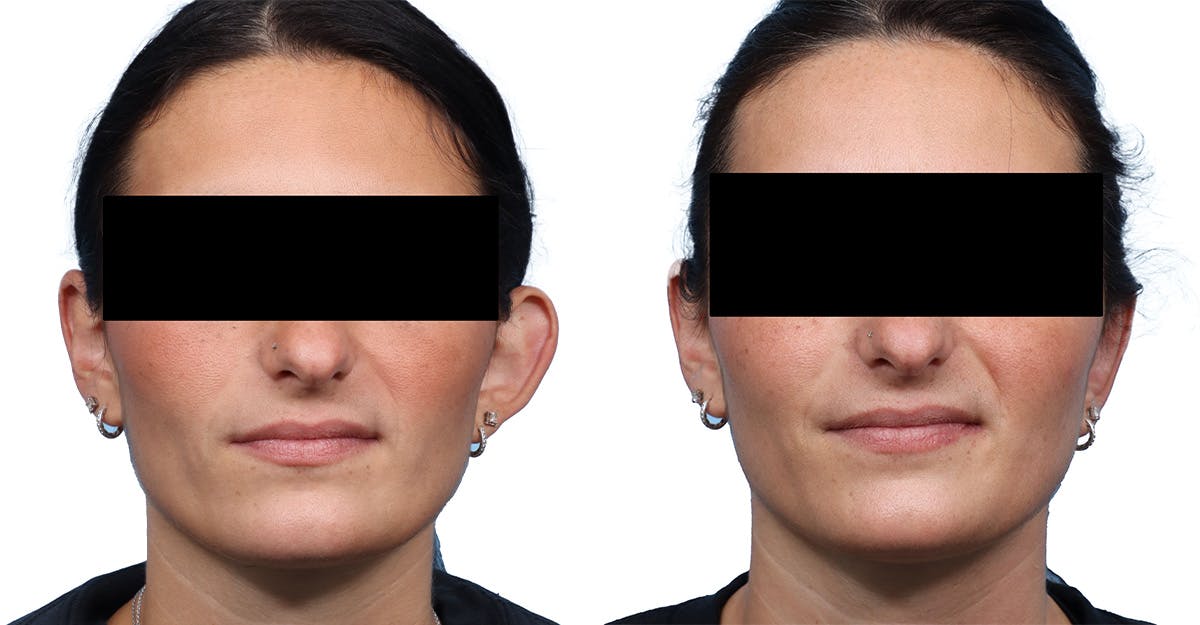 Otoplasty (Ear Surgery) Before & After Gallery - Patient 114465 - Image 1