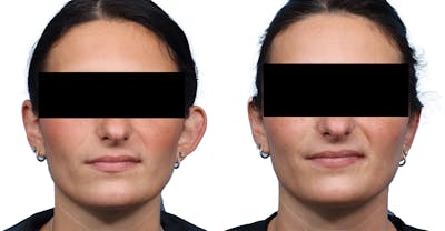 Otoplasty (Ear Surgery) Before & After Gallery - Patient 114465 - Image 1