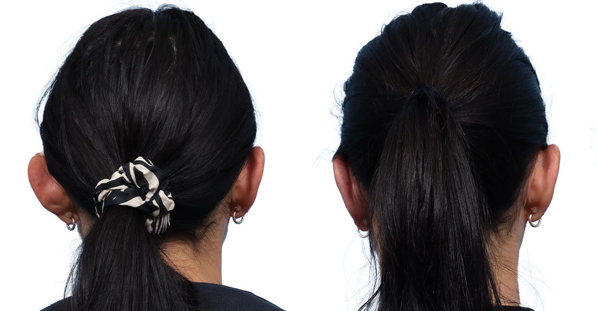 Otoplasty (Ear Surgery) Before & After Gallery - Patient 114465 - Image 2