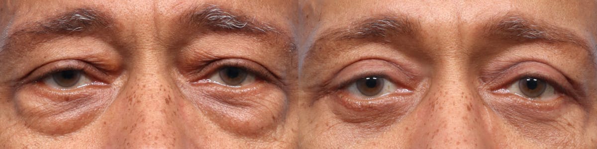 Blepharoplasty (Eyelid Surgery) Before & After Gallery - Patient 175742 - Image 1