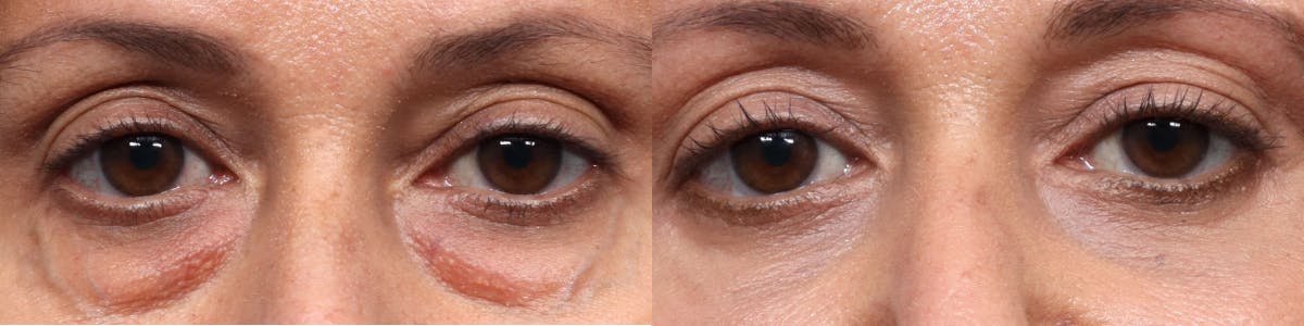 Blepharoplasty (Eyelid Surgery) Before & After Gallery - Patient 263440 - Image 1