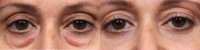 Blepharoplasty (Eyelid Surgery) Before & After Gallery - Patient 263440 - Image 1