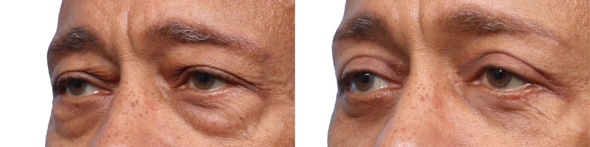 Blepharoplasty (Eyelid Surgery) Before & After Gallery - Patient 175742 - Image 2