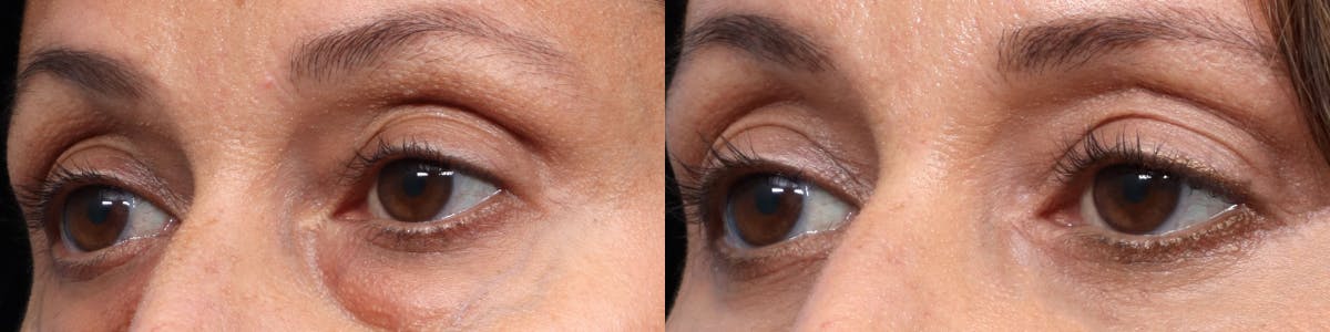 Blepharoplasty (Eyelid Surgery) Before & After Gallery - Patient 263440 - Image 2