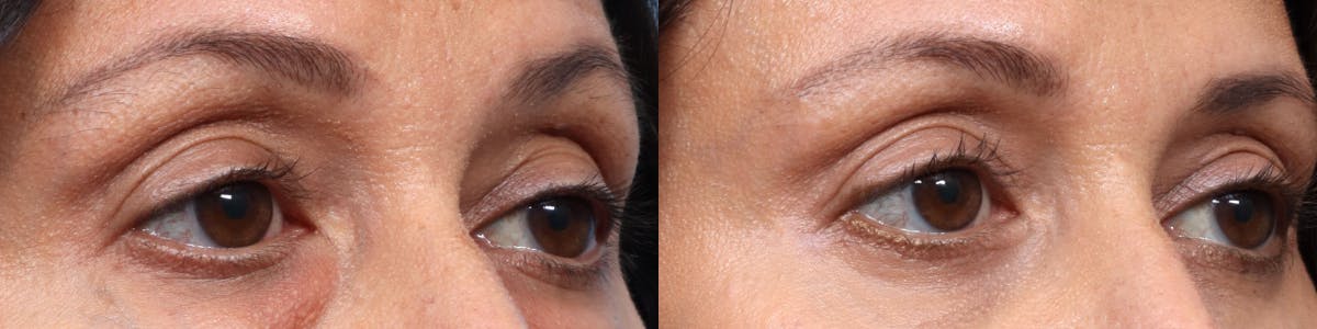 Blepharoplasty (Eyelid Surgery) Before & After Gallery - Patient 263440 - Image 3