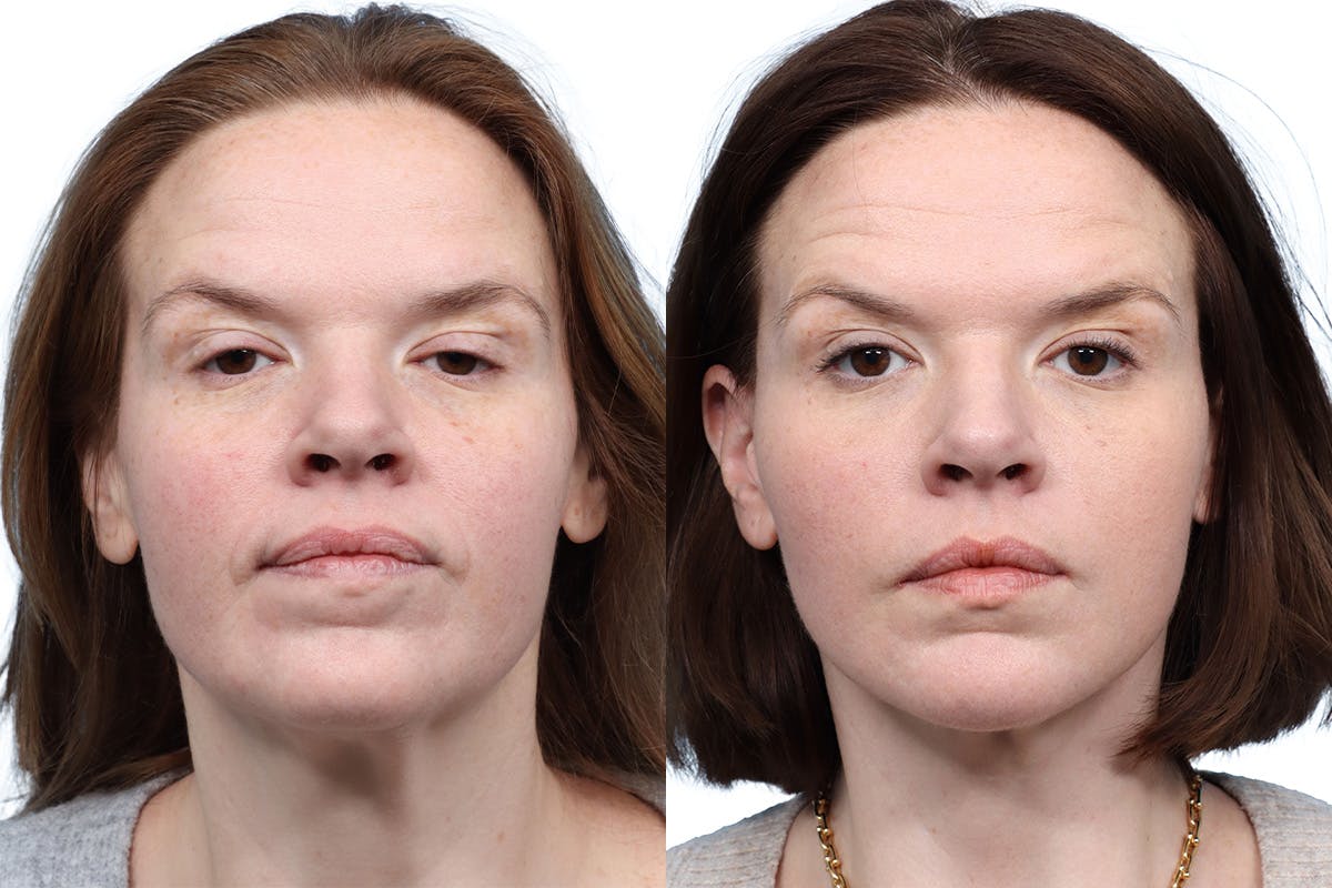 Deep Plane Facelift Before & After Gallery - Patient 686427 - Image 1