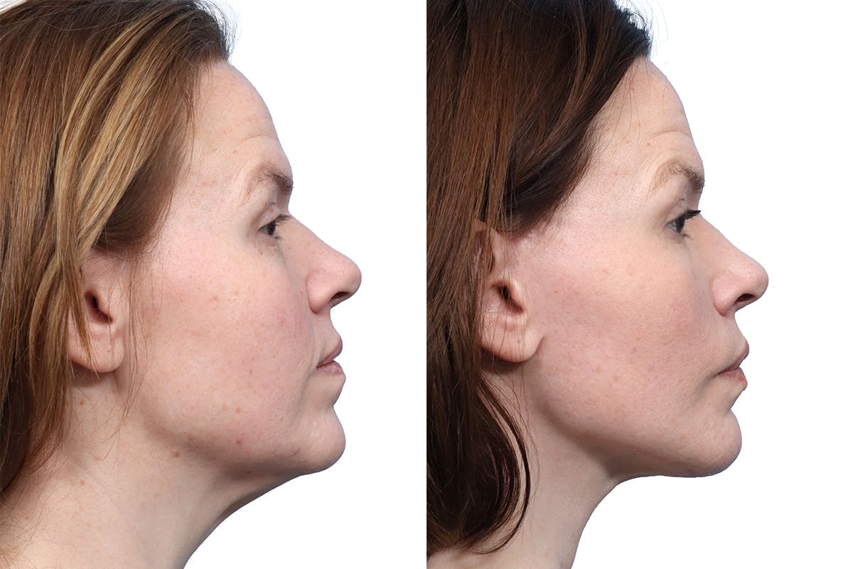 Deep Plane Facelift Before & After Gallery - Patient 686427 - Image 2