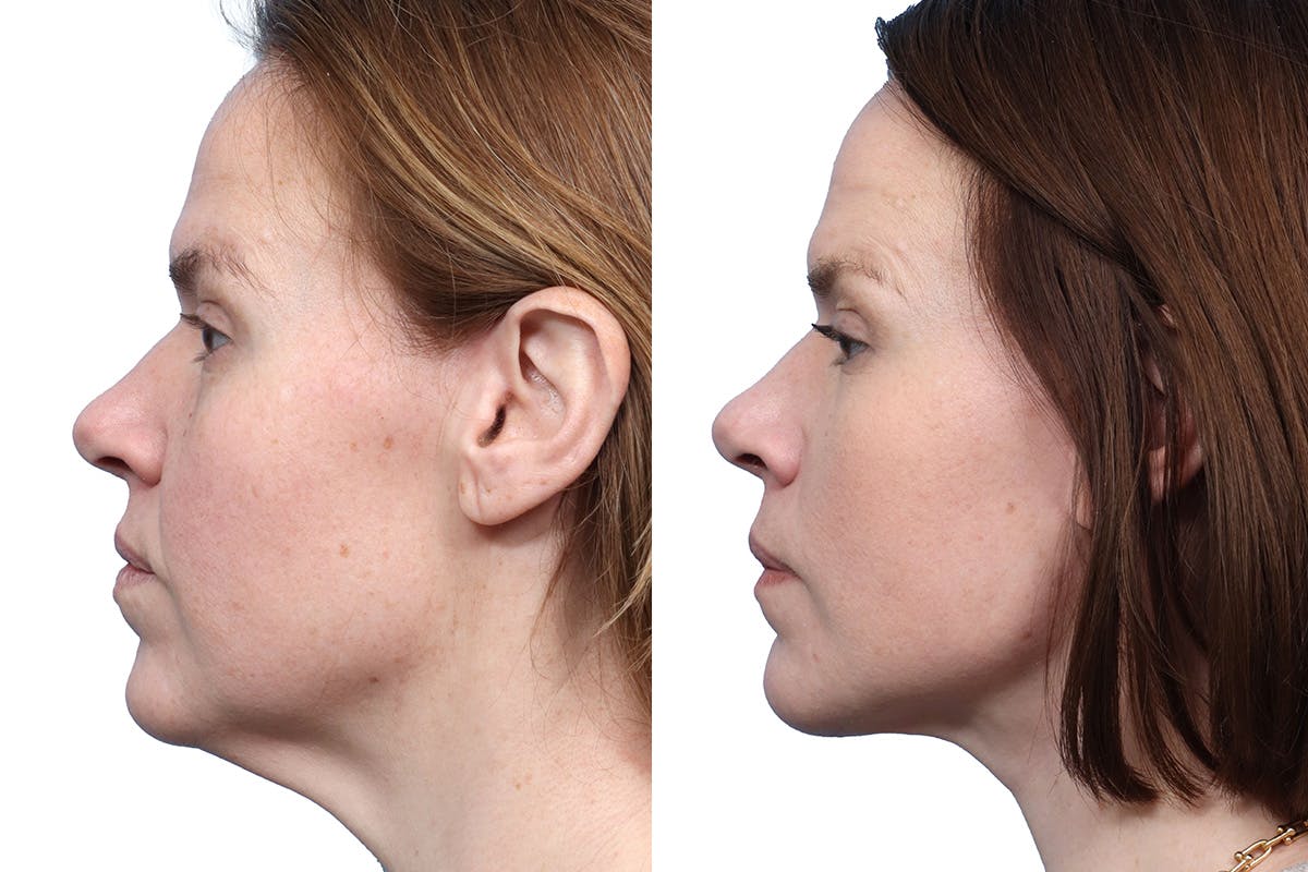 Deep Plane Facelift Before & After Gallery - Patient 686427 - Image 3
