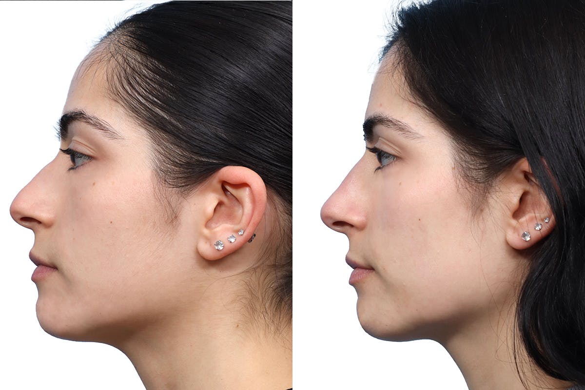 Non-Surgical Rhinoplasty Before & After Gallery - Patient 267926 - Image 2