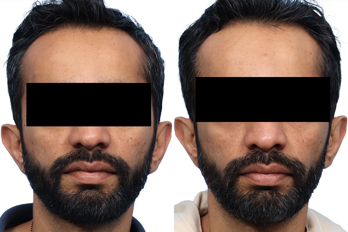 Lutronic Ultra Before & After Gallery - Patient 189866 - Image 3