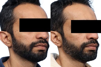Lutronic Ultra Before & After Gallery - Patient 189866 - Image 1