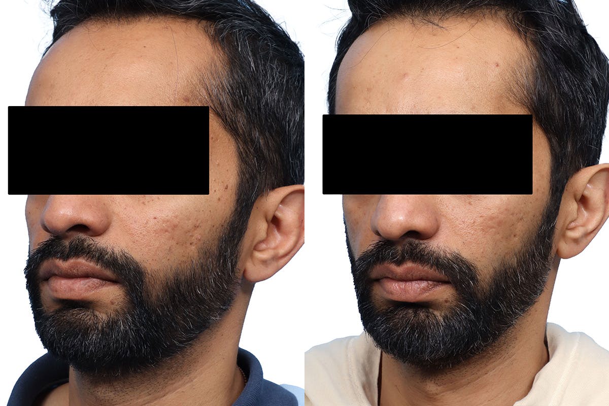 Lutronic Ultra Before & After Gallery - Patient 189866 - Image 2
