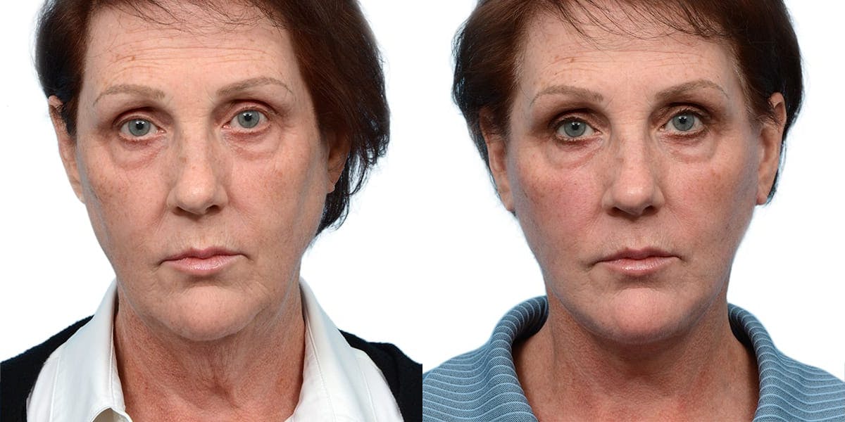 Deep Plane Facelift Before & After Gallery - Patient 964016 - Image 1