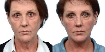 Deep Plane Facelift Before & After Gallery - Patient 964016 - Image 1
