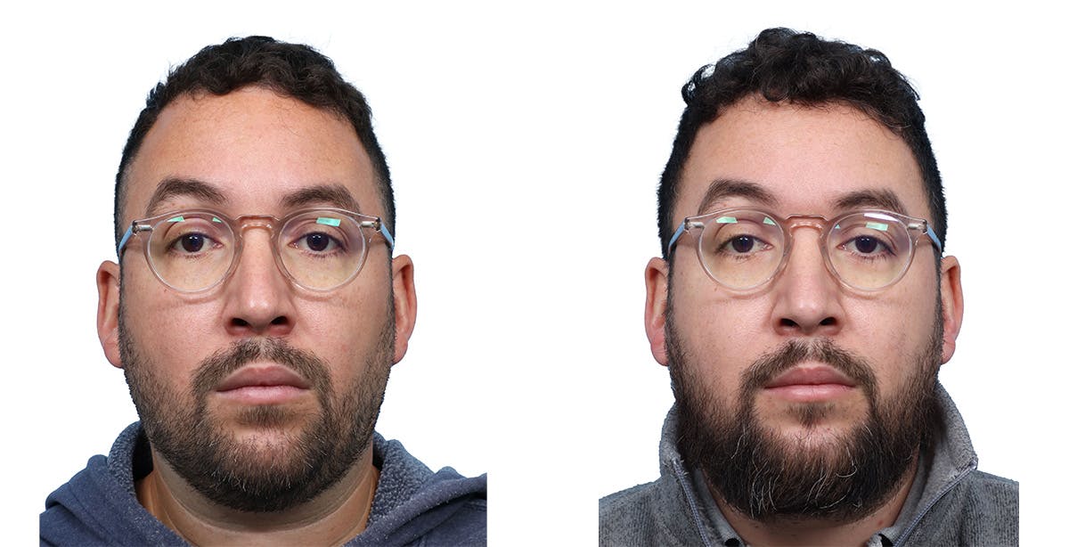 FUE Hair Transplant Before & After Gallery - Patient 357341 - Image 1