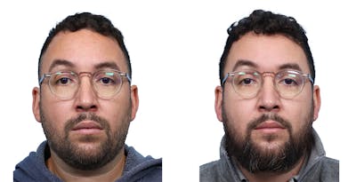 FUE Hair Transplant Before & After Gallery - Patient 357341 - Image 1