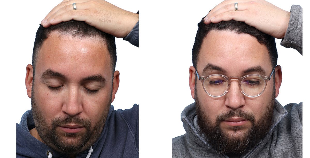 FUE Hair Transplant Before & After Gallery - Patient 357341 - Image 3