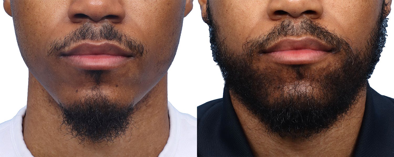 Facial Hair Transplant Before & After Gallery - Patient 551823 - Image 1