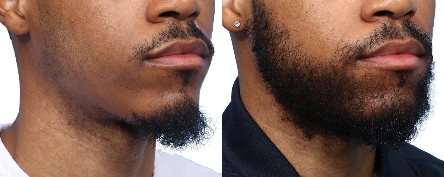 Facial Hair Transplant Before & After Gallery - Patient 551823 - Image 2