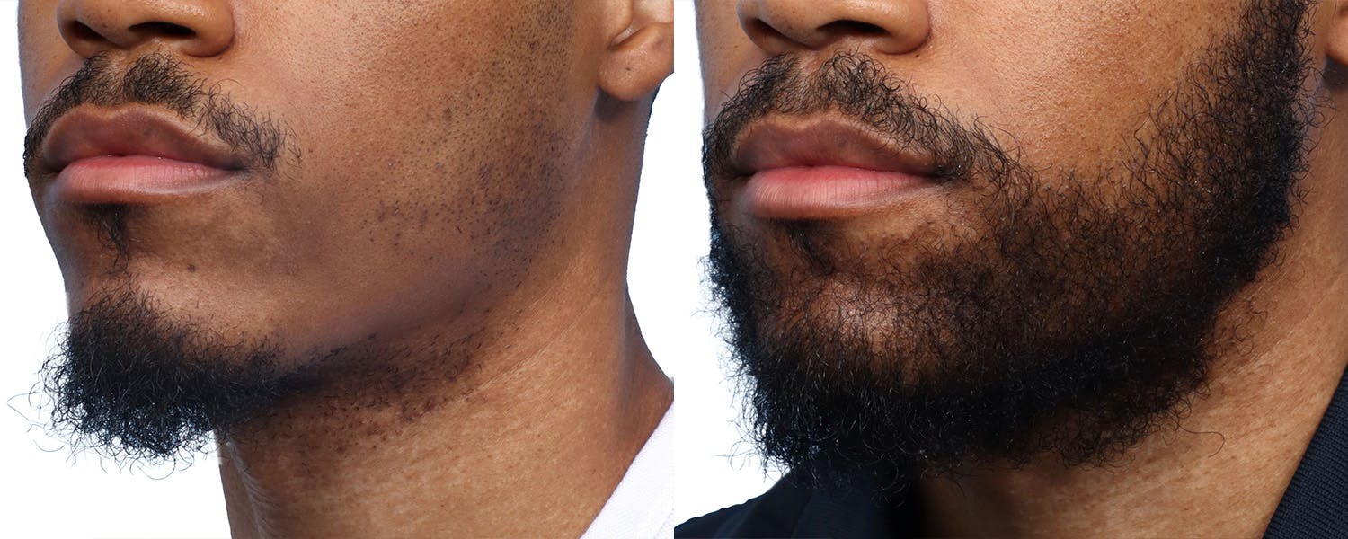 Facial Hair Transplant Before & After Gallery - Patient 551823 - Image 3