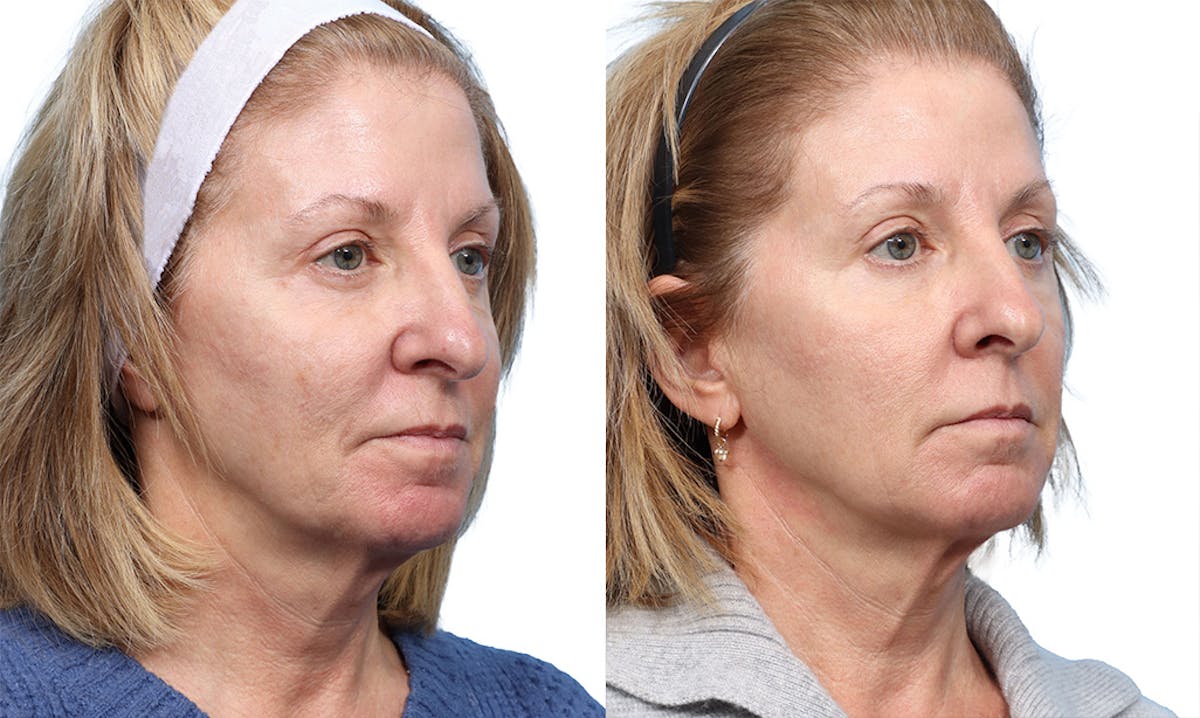 VBeam® Before & After Gallery - Patient 181613 - Image 1
