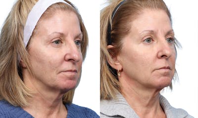 VBeam® Before & After Gallery - Patient 181613 - Image 1