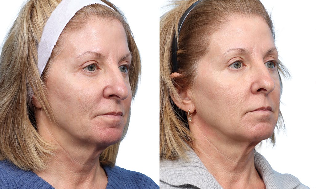 Lutronic Ultra Before & After Gallery - Patient 478806 - Image 1