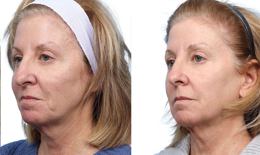 Lutronic Ultra Before & After Gallery - Patient 478806 - Image 2