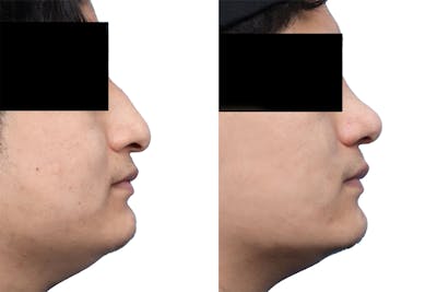 Rhinoplasty Before & After Gallery - Patient 289141 - Image 1
