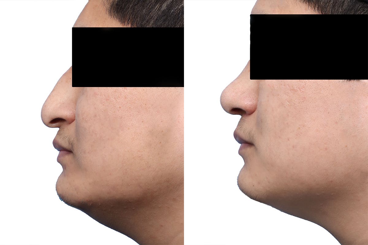 Rhinoplasty Before & After Gallery - Patient 289141 - Image 2