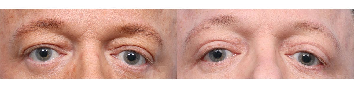 Blepharoplasty (Eyelid Surgery) Before & After Gallery - Patient 121103 - Image 1